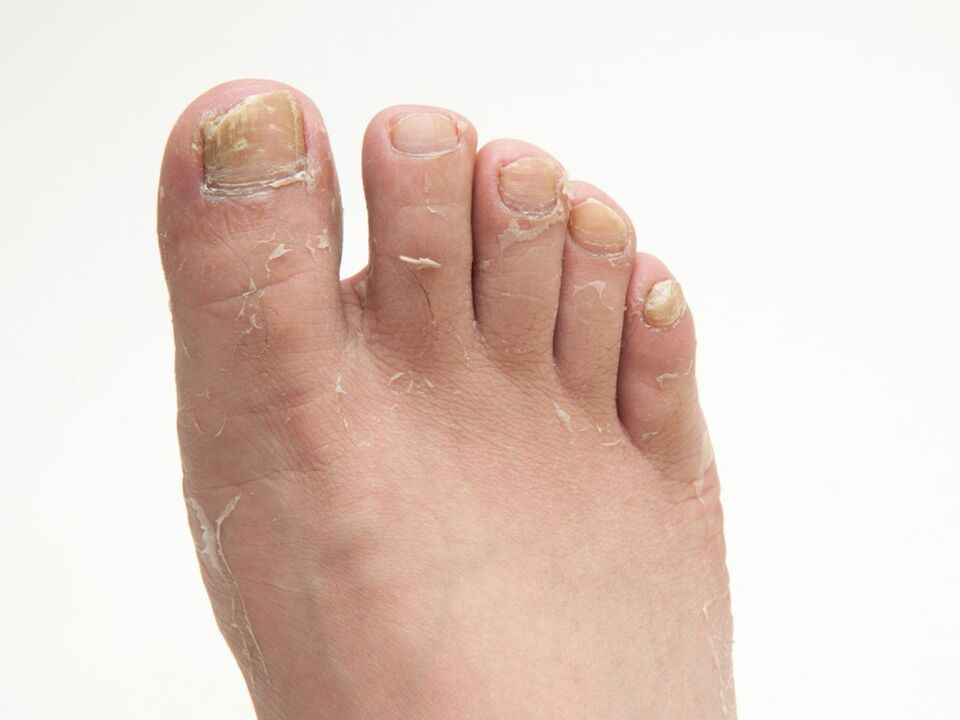 Fungo sulla pelle delle gambe e il suo trattamento con crema demyxil