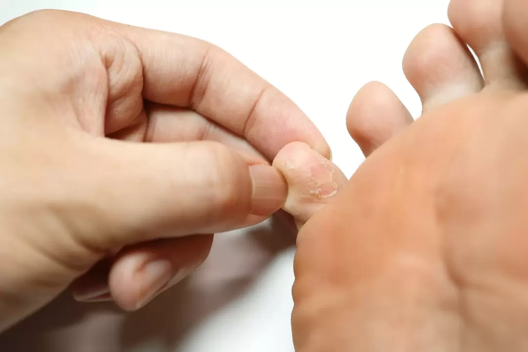 Fungo sulle dita e il suo trattamento con crema demyxil